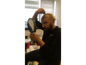Saç ekim uzmanı, kendi saçını kendi ekti