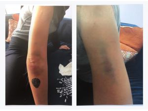 Sıla’nın Darp Sonucu Vücudunda Oluşan Morlukların Fotoğrafları Ortaya Çıktı