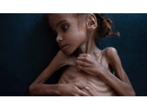 Yemen İç Savaşının Sembolü Küçük Emel Hayatını Kaybetti