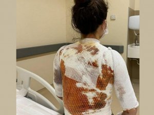 Eşinin Kaynar Suyla Yaktığı Rukiye A: “Ölmek İstemiyorum”
