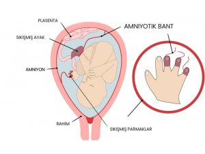 Amniyotik Bant Sendromu Olan Bebekler Anne Karnında Ameliyat İle Tedavi Edilebiliyor