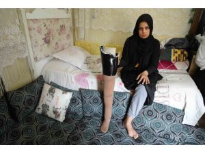 KAHRAMANMARAŞ MERKEZLİ BÜYÜK DEPREMDE BACAĞINI KAYBETTİ, EŞİ TERK ETTİ
