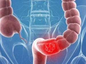 KOLON KANSERİNDE YAŞ SINIRI GİDEREK DÜŞÜYOR