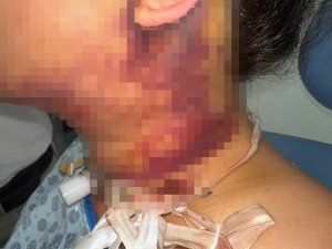 ESTETİK AMELİYATI SONRASI DOKTOR HAKKINDA ŞİKAYETÇİ OLDU