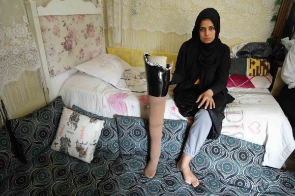 KAHRAMANMARAŞ MERKEZLİ BÜYÜK DEPREMDE BACAĞINI KAYBETTİ, EŞİ TERK ETTİ