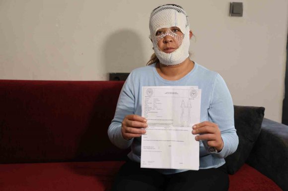 GÜZELLEŞMEK UĞRUNA GİTTİĞİ MERKEZDE YÜZÜ YANDI