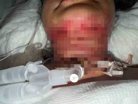 GIDI ESTETİĞİ SONRASI NEFES ALAMADI, BOYNUNDAN ACİL SOLUNUM YOLU AÇILDI